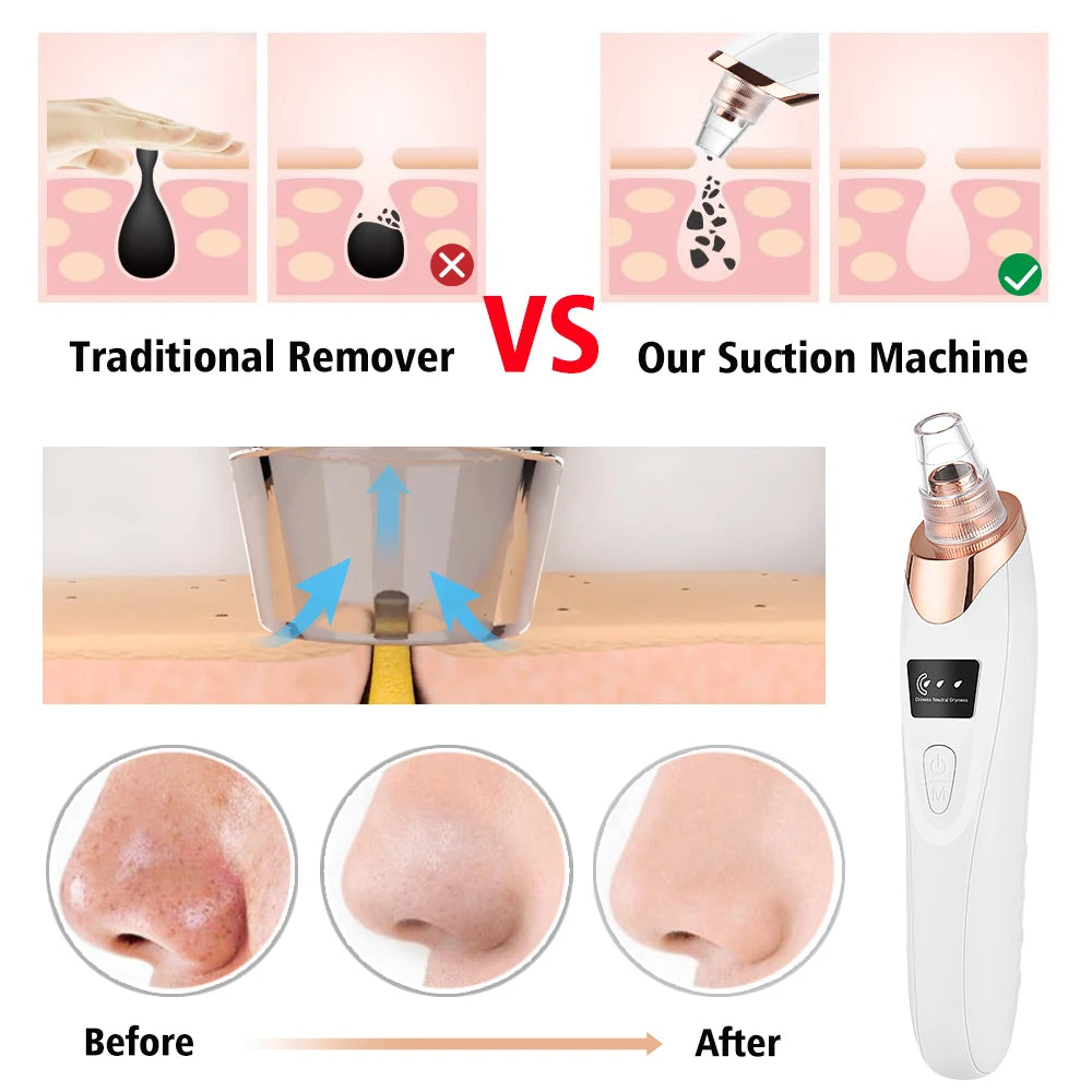 3-Mode Blackhead Remover – Electric Pore Vacuum & Deep Facial Cleansing Tool