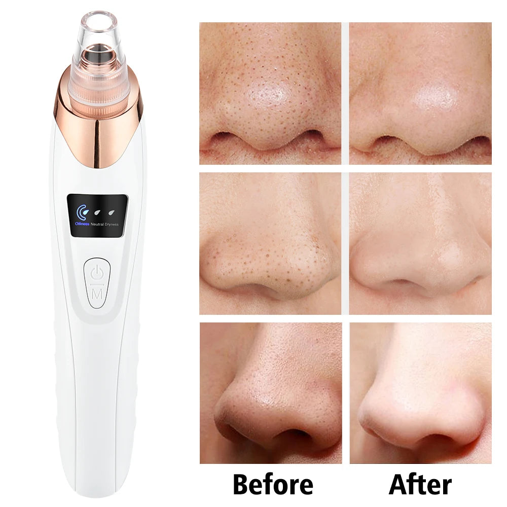 3-Mode Blackhead Remover – Electric Pore Vacuum & Deep Facial Cleansing Tool